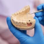 Wisdom Teeth Woes: Why Those Third Molars Might Need to Go