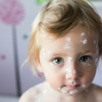 What to Do When Your Children Have Chickenpox: A Parent's Guide to Managing the Itch