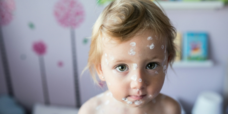 What to Do When Your Children Have Chickenpox: A Parent's Guide to Managing the Itch